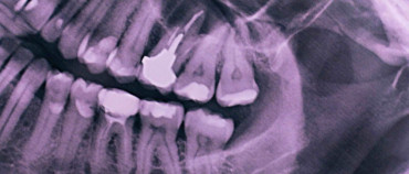 Guide to Wisdom Teeth Removal: What to Expect Before, During, and After Surgery