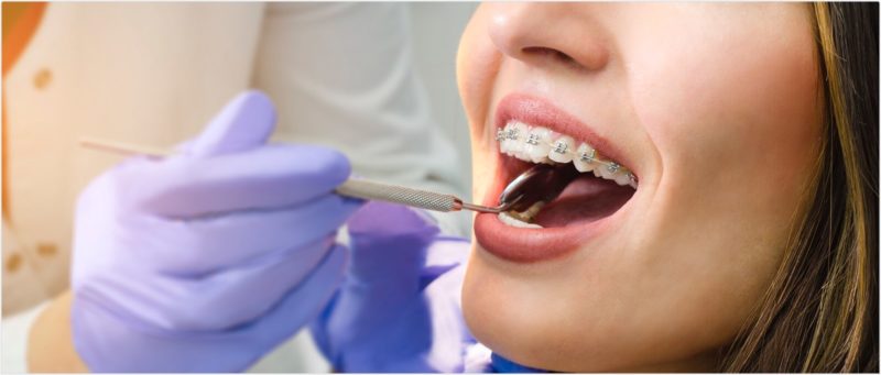 Orthodontic Treatments