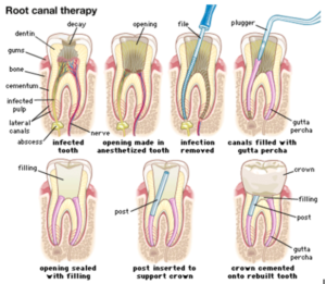 root canal treatment melbourne