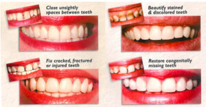 porcelain veneers narre warren
