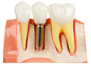 Dental Implants Dandenong