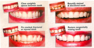 porcelain veneers narre warren
