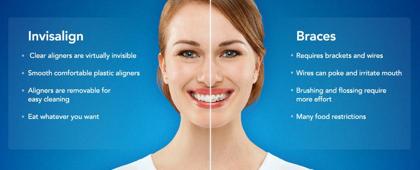 Invisalign Braces