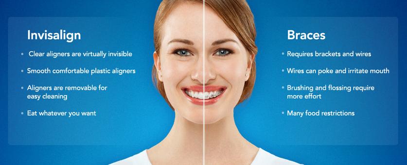 Invisalign Braces