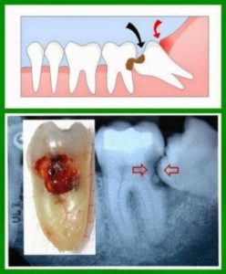 wisdom teeth removal melbourne