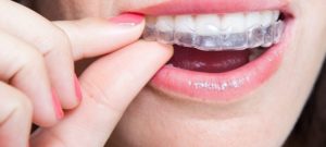 Dental Clinic Endeavour Hills | Invisalign Clear Aligners