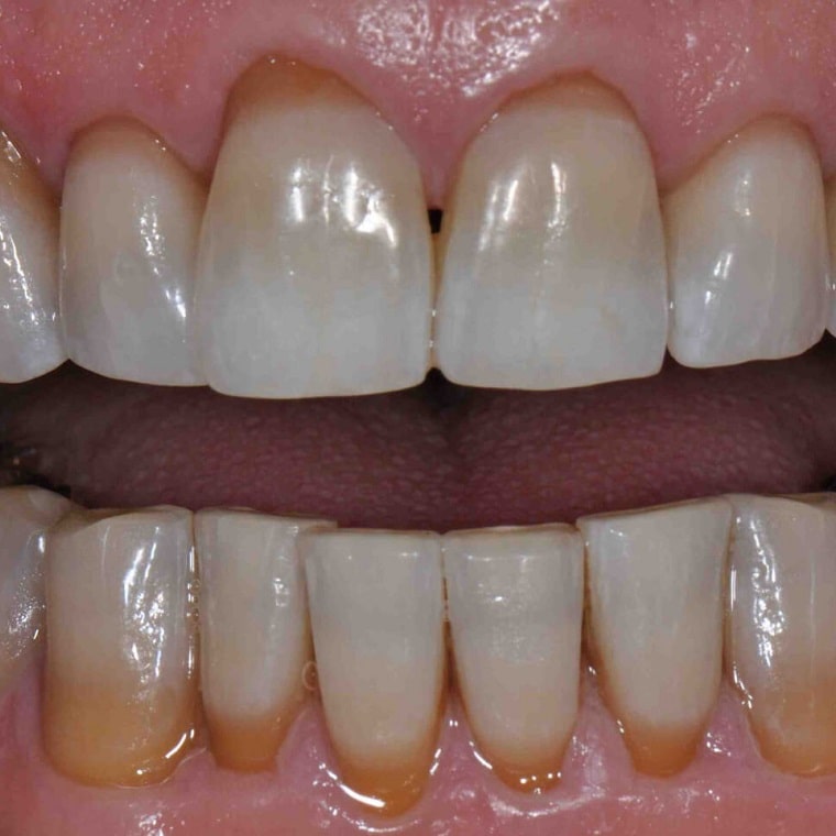 Stained Discoloured Teeth