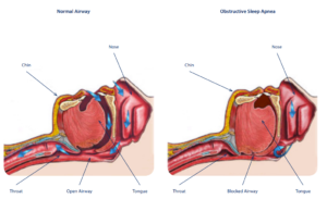 Obstructive Sleep Apnoea (OSA)