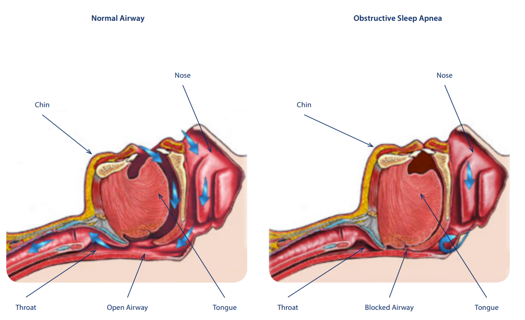 sleep apnoea