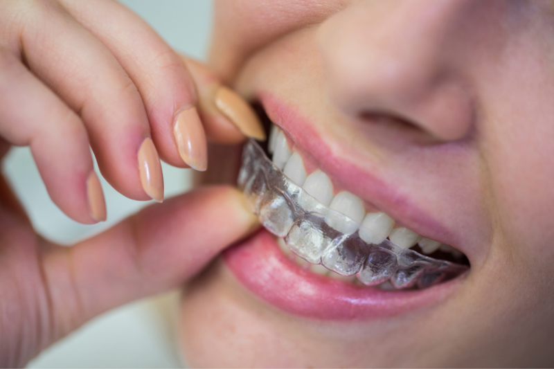 Invisalign: A Comprehensive Guide