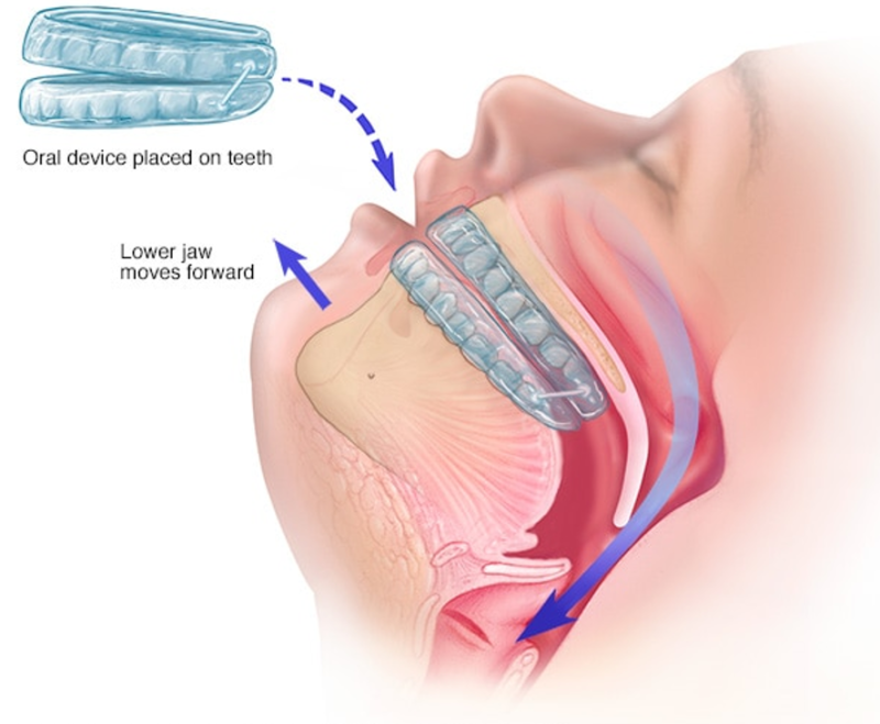 How to treat Sleep Apnoea?