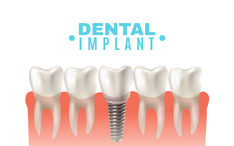 Is It Painful to Get Dental Implants? Totally Teeth | Blogs