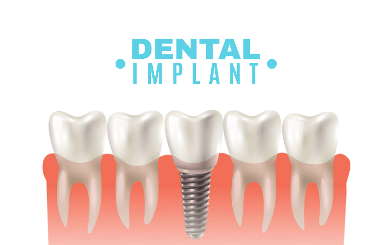 Is It Painful to Get Dental Implants?