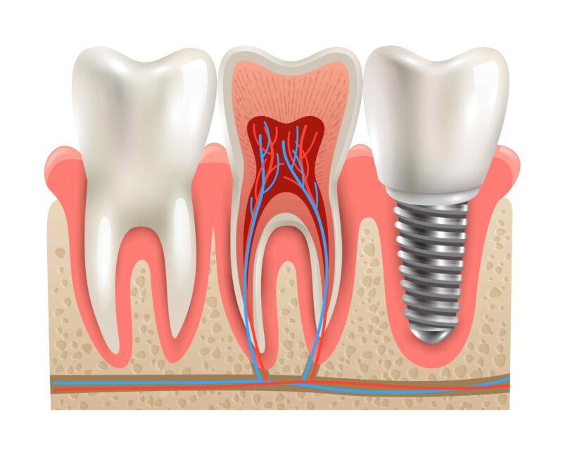 How Dental Implants Can Revitalise Your Oral Health?
