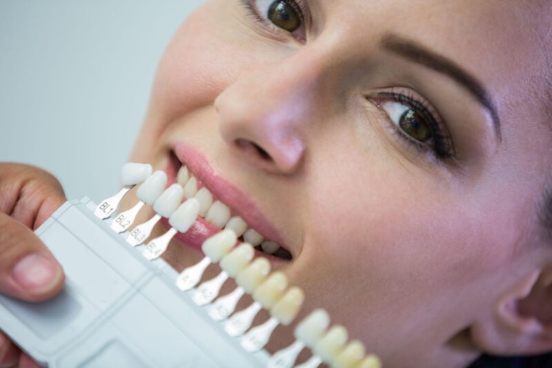 Porcelain Veneers: Everything You Need to Know Before Transforming Your Smile