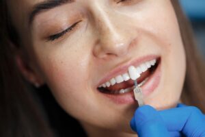 Porcelain Veneers Melbourne