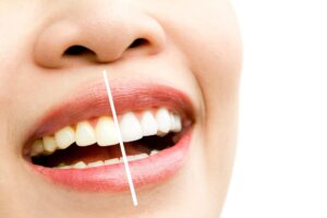 Professional Teeth Whitening