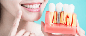 Dental Implants Melbourne