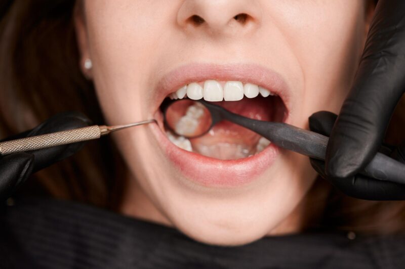 Professional Teeth Whitening